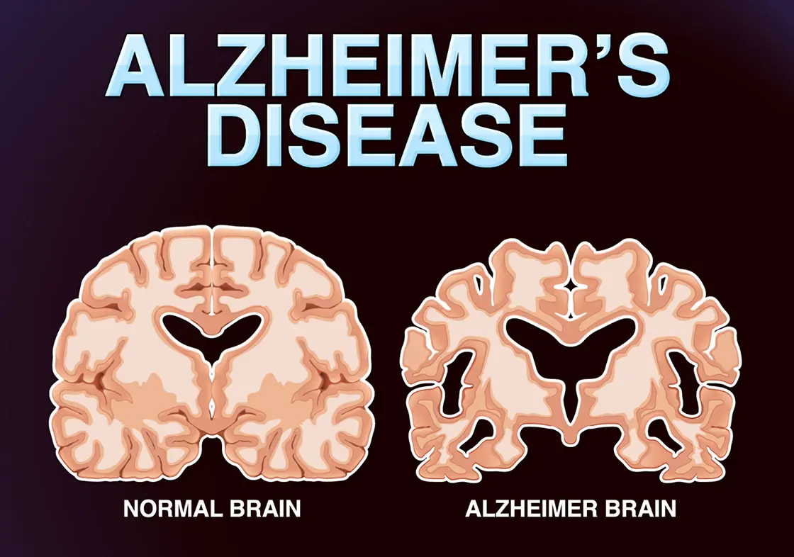 brain condition as shrinking in the alzheimer's disease